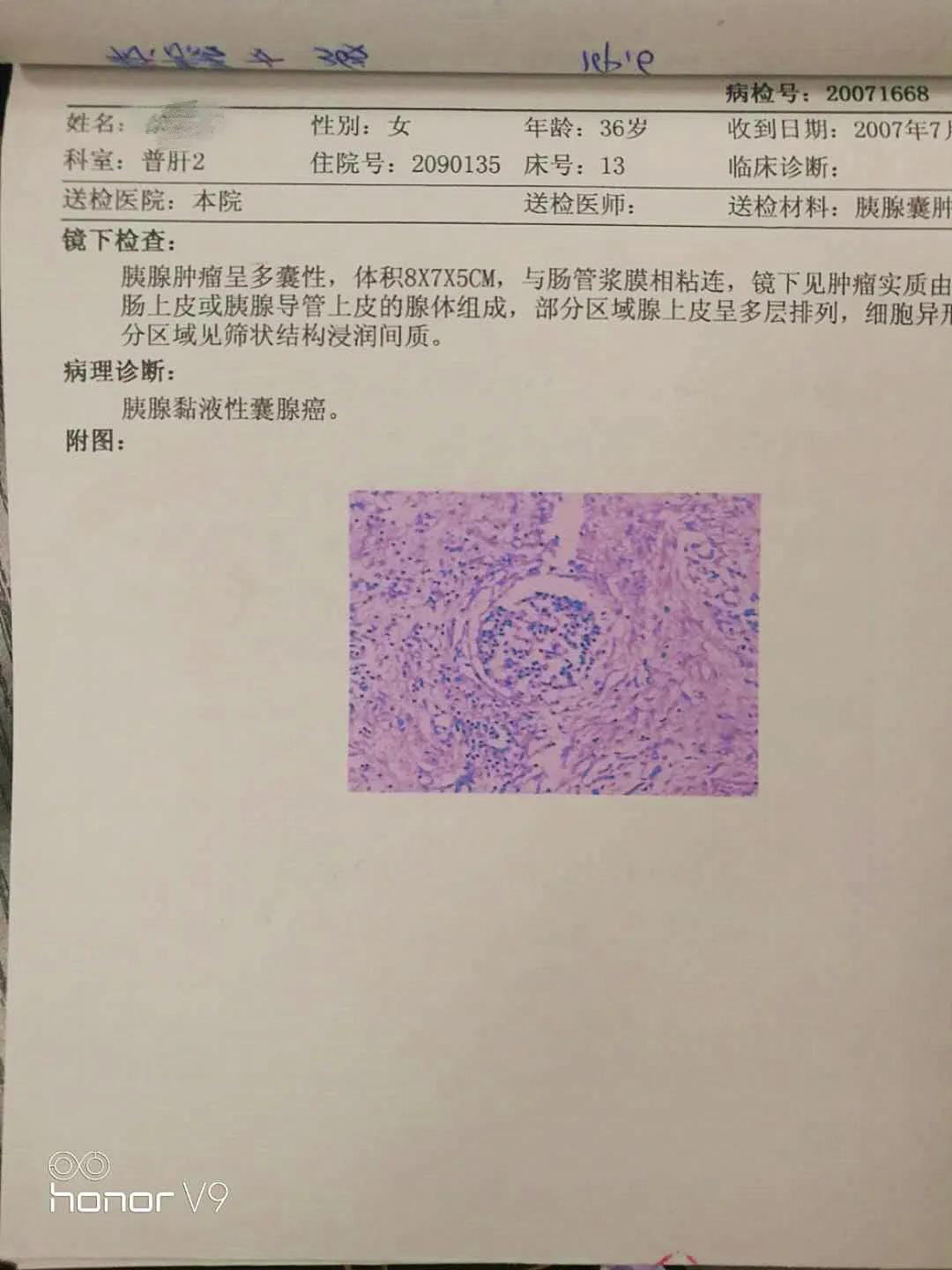 老人肺腺癌患者的生存期限、影响因素与生存质量分析